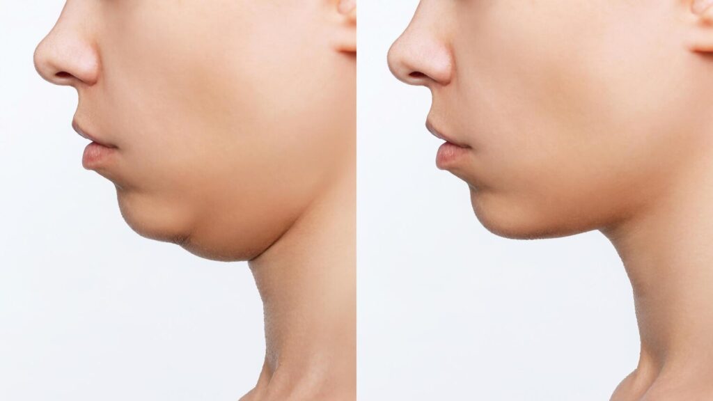 Liposuction double chin cropped shot woman s face with chin before after plastic surgery 407348 1992