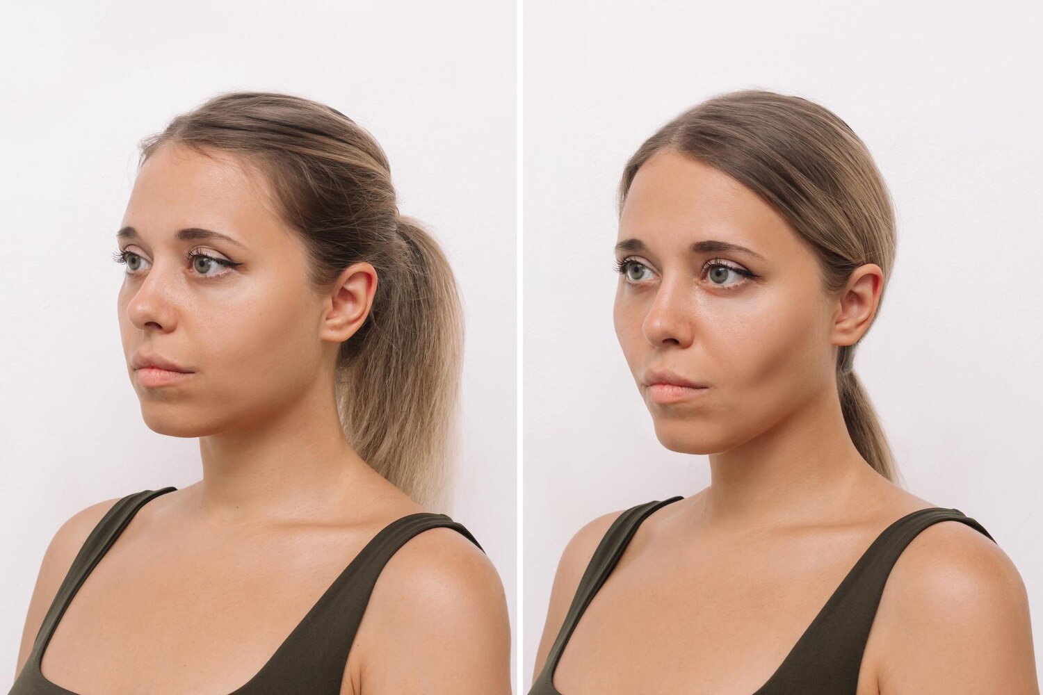 Young blonde woman s face before after plastic surgery buccal fat pad removal 407348 2593
