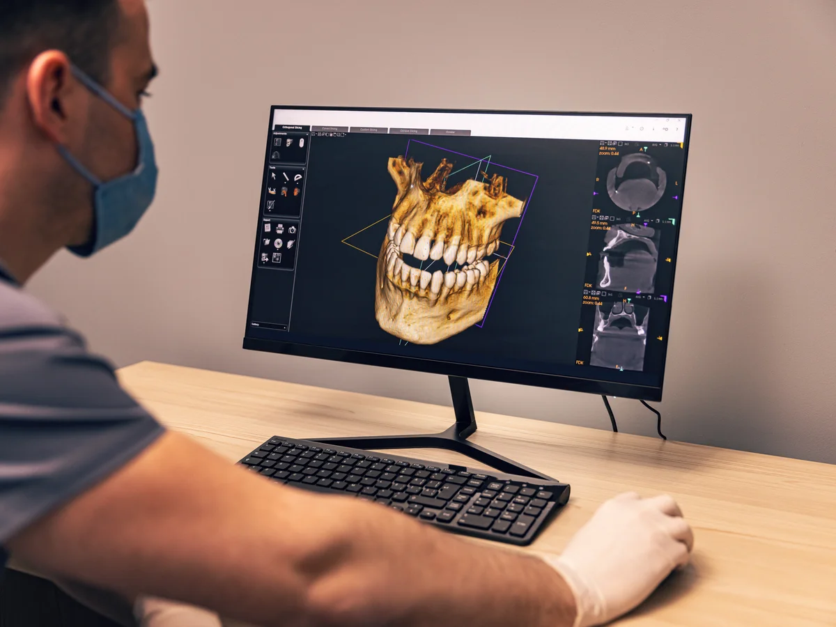 Implantes faciais definitivos - próteses faciais - harmonização facial definitiva